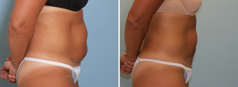 Vaser Lipo Abdomen