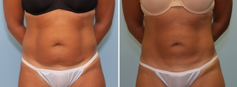Vaser Lipo Abdomen