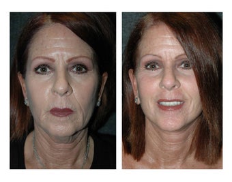 Lower Facelift and Necklift for Dramatic, Natural-Appearing Rejuvenation