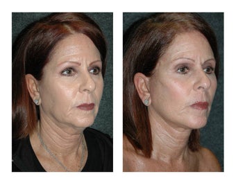 Lower Facelift and Necklift for Dramatic, Natural-Appearing Rejuvenation