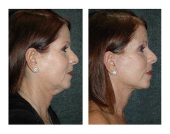 Lower Facelift and Necklift for Dramatic, Natural-Appearing Rejuvenation