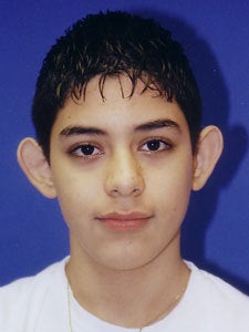 Otoplasty Ear Surgery - Male Child