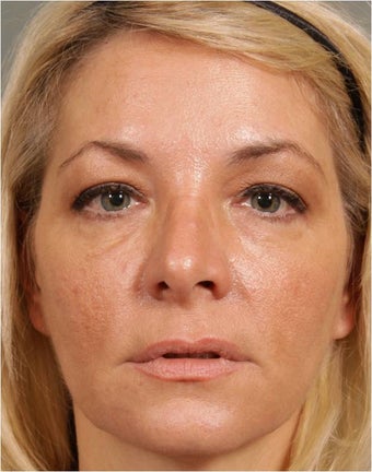 47 year old female treated for loss of volume under eyes, cheeks, and lips