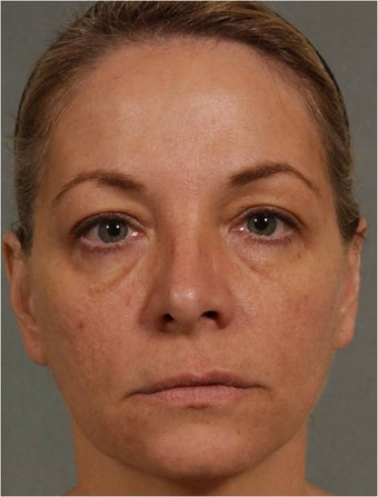 47 year old female treated for loss of volume under eyes, cheeks, and lips