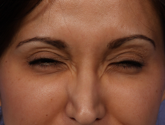 Botox for Crows Feet