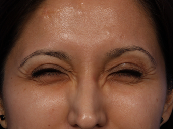 Botox for Crows Feet