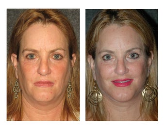 Facelift and Chin Implant for Dramatic Improvement in Jawline and Neck