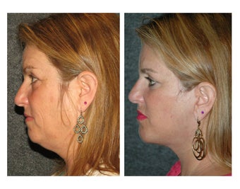 Facelift and Chin Implant for Dramatic Improvement in Jawline and Neck