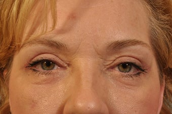 Lower Lid Hetter Peel