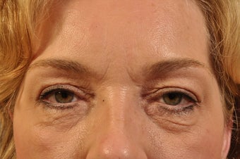 Lower Lid Hetter Peel