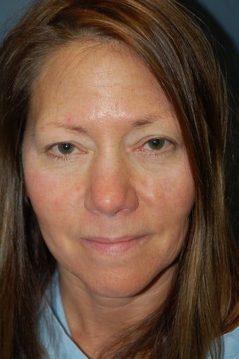 Nose Surgery
