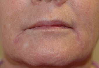Juvederm