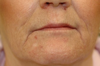 Juvederm