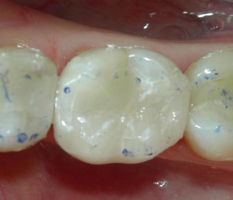 Silver Filling Replaced by Composite Filling