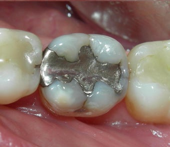Silver Filling Replaced by Composite Filling