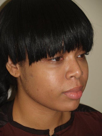 Before and After Buccal Fat Removal