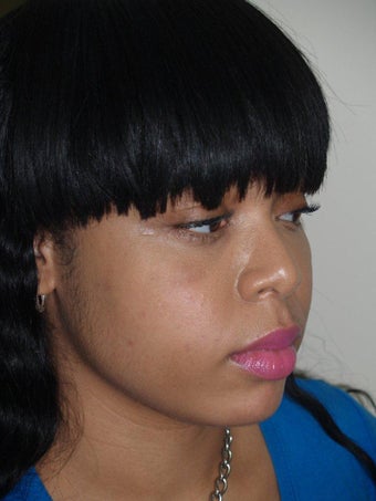 Before and After Buccal Fat Removal