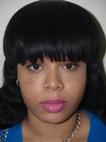 Before and After Buccal Fat Removal