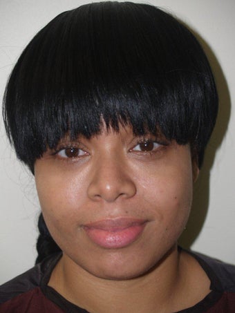 Before and After Buccal Fat Removal