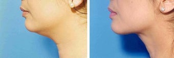Chin Liposuction