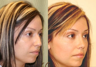 Natural Rhinoplasty 