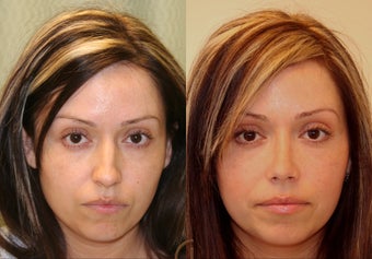 Natural Rhinoplasty 