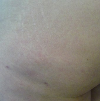Cellulite Treatment
