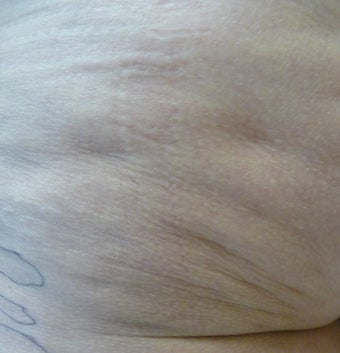 Cellulite Treatment