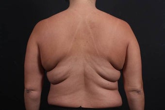 This 39 year old female underwent the Bra Line Back Lift procedure