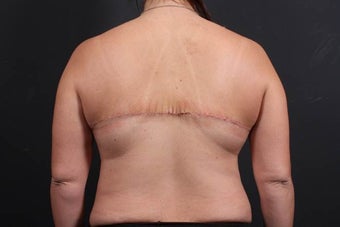 This 39 year old female underwent the Bra Line Back Lift procedure