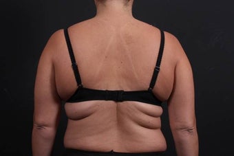This 39 year old female underwent the Bra Line Back Lift procedure
