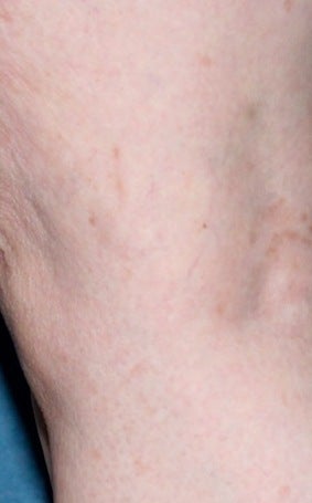Sclerotherapy