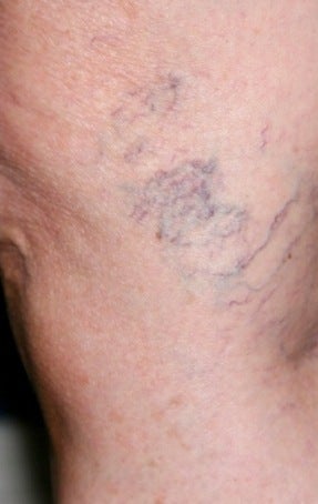 Sclerotherapy