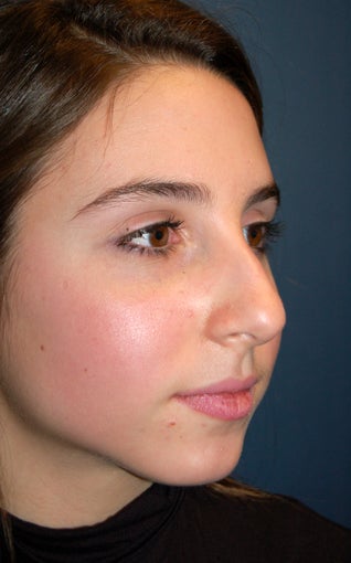 Nose Surgery