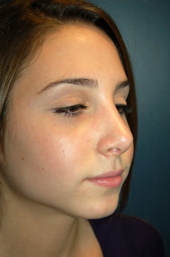 Nose Surgery