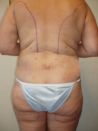 Liposuction of Buttocks and Hips