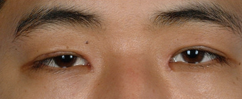 Asian Blepharoplasty