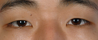 Asian Blepharoplasty