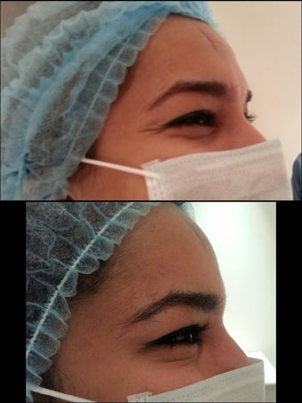 25 yrs old with crows feet (wrinkles around the eyes
