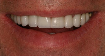 55 Year Old Male gets Smile Makeover
