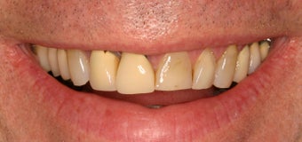 55 Year Old Male gets Smile Makeover
