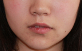 Fillers to Nasolabial Folds/Midface