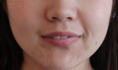 Fillers to Nasolabial Folds/Midface