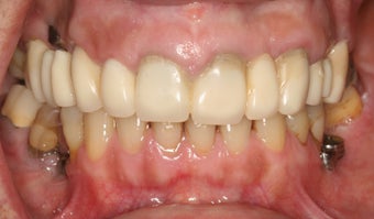 Full mouth reconstruction, bad dental implants