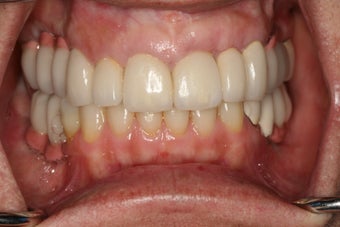 Full mouth reconstruction, bad dental implants