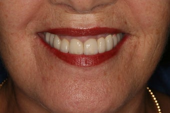 Full mouth reconstruction, bad dental implants