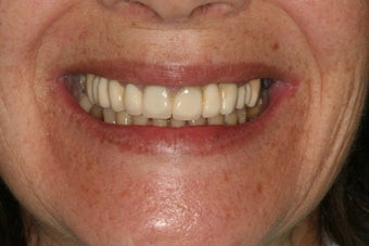 Full mouth reconstruction, bad dental implants