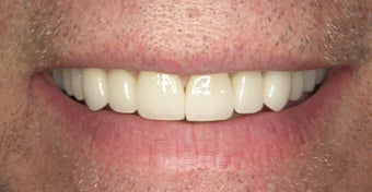 Smile Design