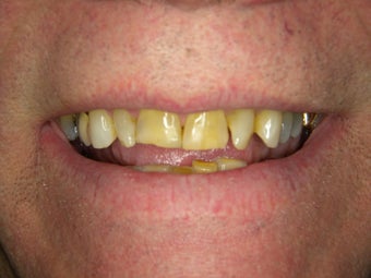 Smile Design