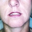 36 year old female patient 